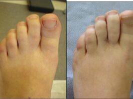 Webbed Toes and How They’re Treated