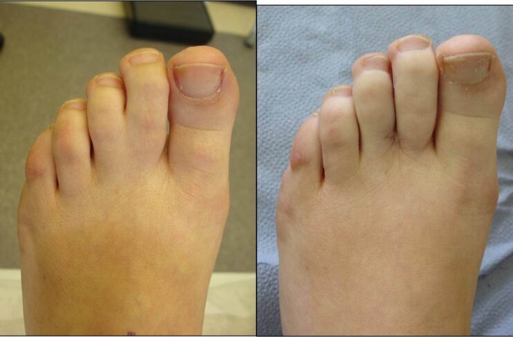 Webbed Toes and How They’re Treated