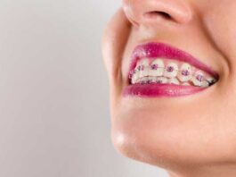 The Benefits Of Accelerated Braces For Teens And Adults In Winnipeg
