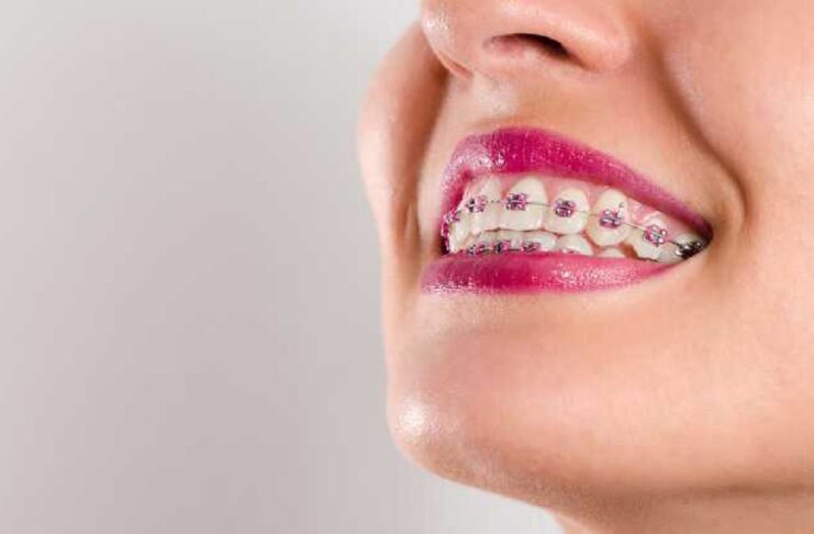 The Benefits Of Accelerated Braces For Teens And Adults In Winnipeg